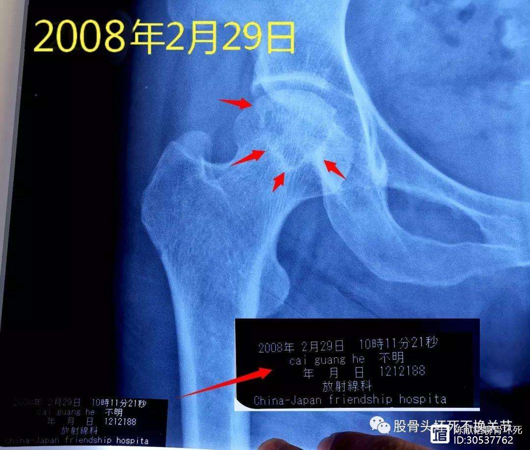 南京人工骨头医保报销多少(人工骨头医保报销多少比例)